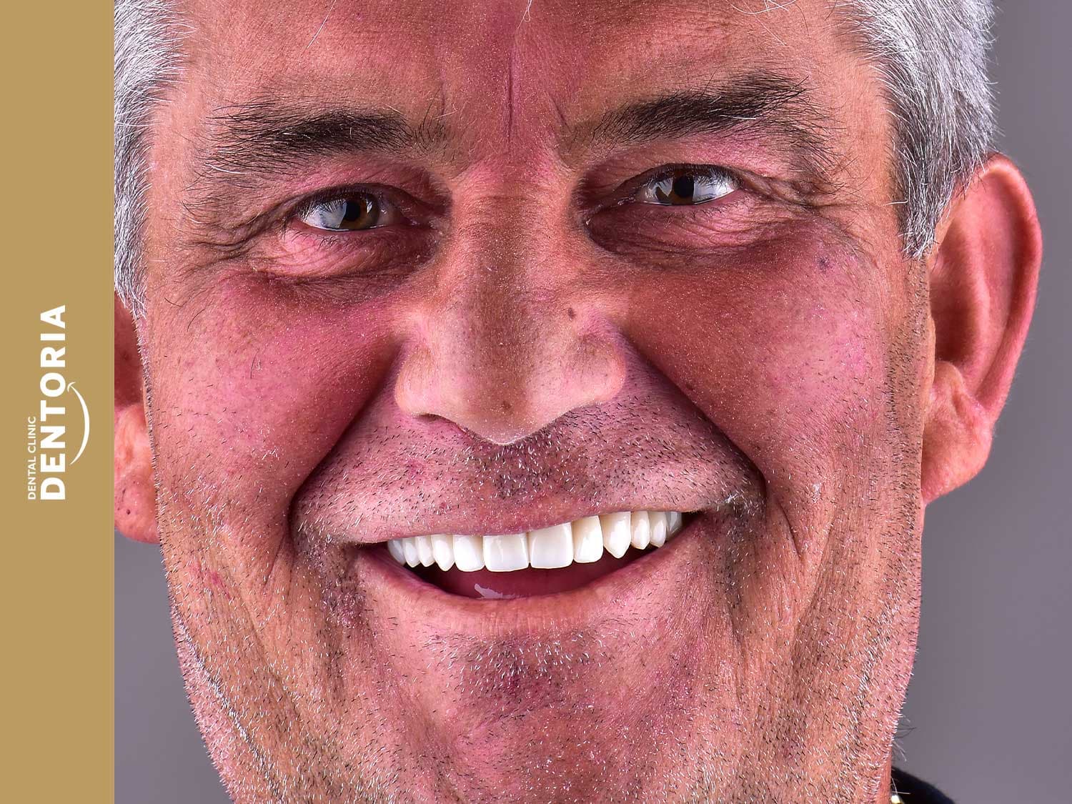 Smile Design · ceramic veneers